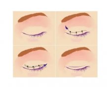 不同方式做雙眼皮的費用