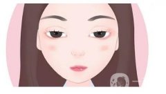 雙眼皮手術(shù)的方法有幾種