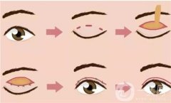 雙眼皮手術(shù)后的康復(fù)過(guò)程