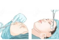 雙眼皮手術(shù)后需要注意什么事項