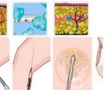 小腿吸脂后痛嗎，多久能恢復呢？