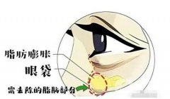 眼袋去除手術(shù)失敗怎么辦？