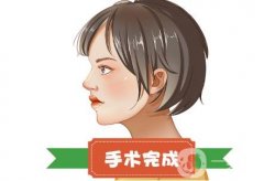 鷹鉤鼻矯正的原理是什么