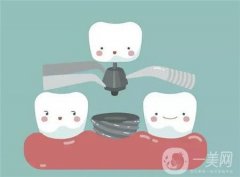 種植牙的價格影響因素