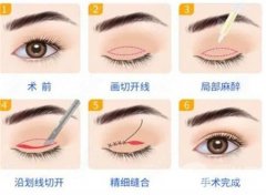 做完雙眼皮手術(shù)后的恢復(fù)時(shí)間