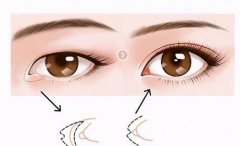 開(kāi)眼角手術(shù)失敗修復(fù)的成本貴嗎？