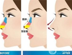 隆鼻修復(fù)后可能出現(xiàn)的問(wèn)題或并發(fā)癥