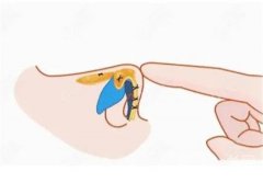 埋線減肥的禁忌和注意事項(xiàng)