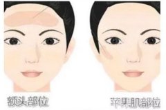 面部抽脂后面部會(huì)不會(huì)凹陷