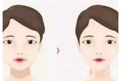面部吸脂手術(shù)前后的注意事項