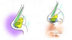哪些情況下適合進(jìn)行鼻孔縮小手術(shù)呢？