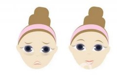 內(nèi)切眼袋手術(shù)是否會對視力有影響