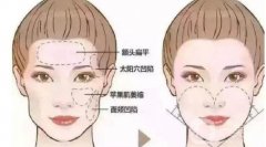 切眉術(shù)后的護(hù)理與注意事項