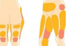 溶脂針減肥有哪些危害