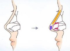 如何應(yīng)對膨體隆鼻后的效果不理想？