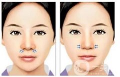 如何預(yù)防隆鼻假體取出后留下疤痕？