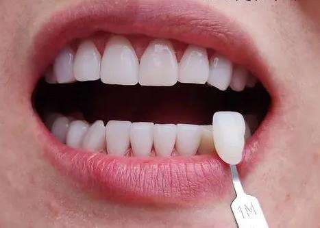 想要擁有耀眼笑容？不可錯過的金鈀合金烤瓷牙價格優(yōu)惠