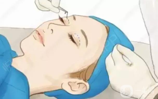 *開眼角貴嗎 價(jià)位大概是在多少