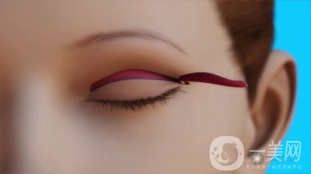 *開眼角貴嗎？價格是多少？